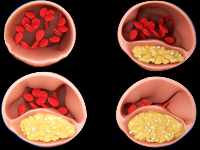 Arteriosklerose Symptome und Behandlung