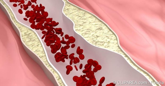 Arteriosklerose ursachen diagnose