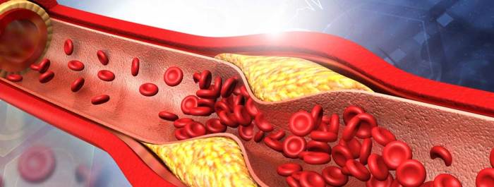 Arteriosklerose risikofaktoren ursachen behandlung symptome heilen kann