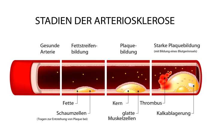 Arteriosklerose bulimie symptome definition ursachen arztsuche plaques krankheiten gefäße