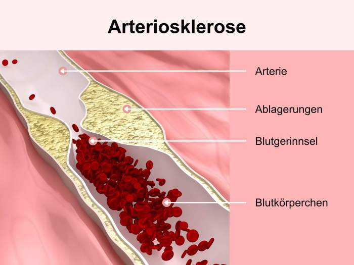 Arteriosklerose Symptome und Behandlung