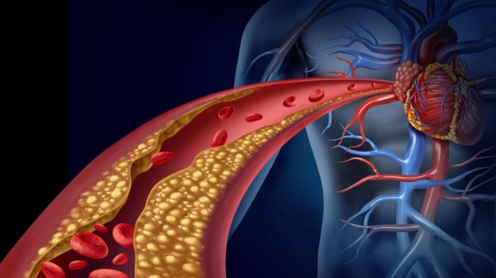 Atherosclerosis blood disease flow plague blocking 3d feet rendering closeup illustration stock shutterstock search pic preview