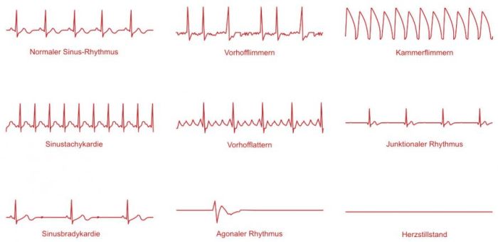 Herzrhythmusstörungen behandeln