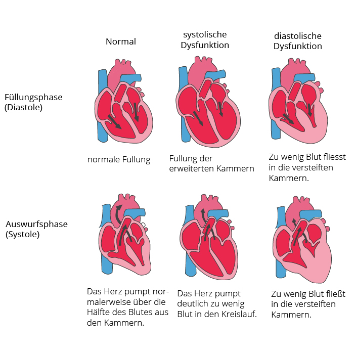 Herzinsuffizienz frühzeitig erkennen