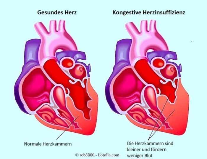 Herzinsuffizienz globale ratgeber vorwärts rückwärts globalen zwei herzens