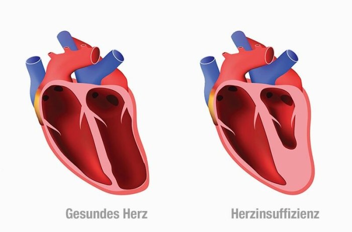 Herzschwäche vorbeugen