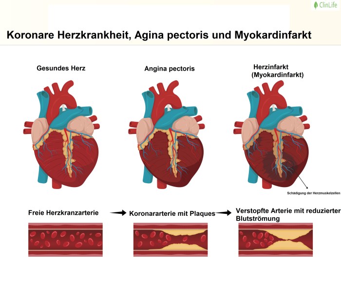 Herz-Kreislauf-Erkrankungen vorbeugen