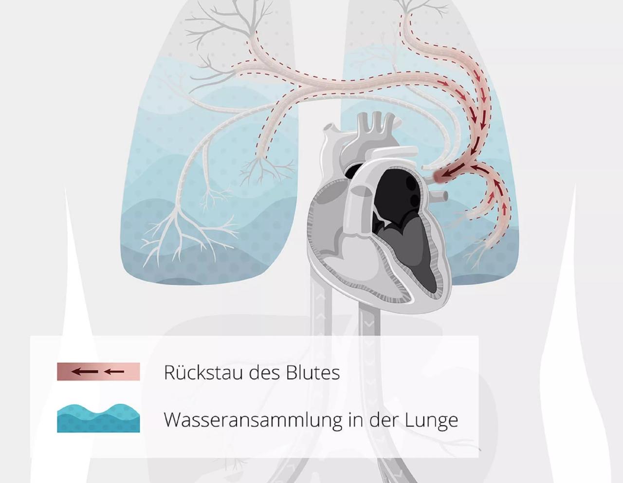 Herzinsuffizienz frühzeitig erkennen